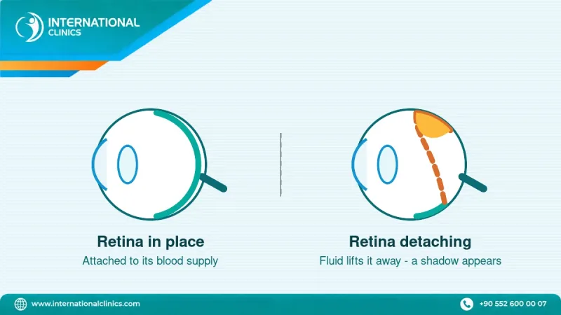 Diagram of a detached retina lifting away from the back of the eye with the five warning signs labelled