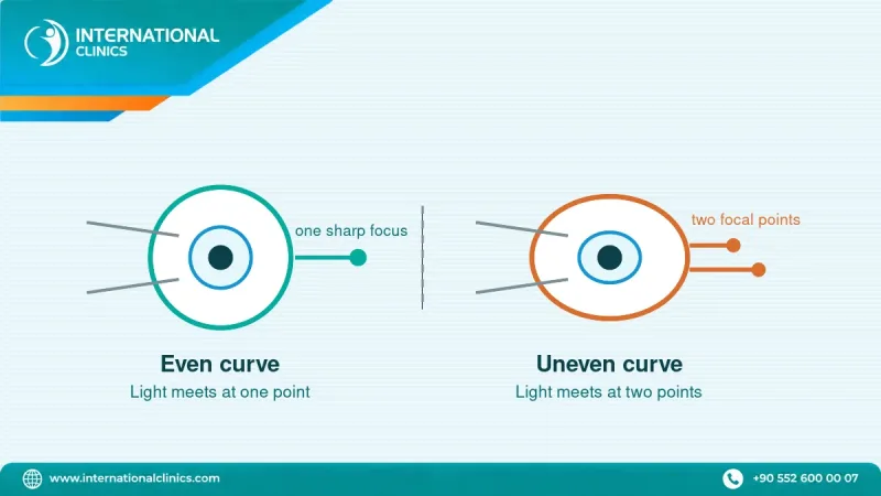 Diagram comparing an evenly curved cornea with an astigmatic cornea that focuses light at two points