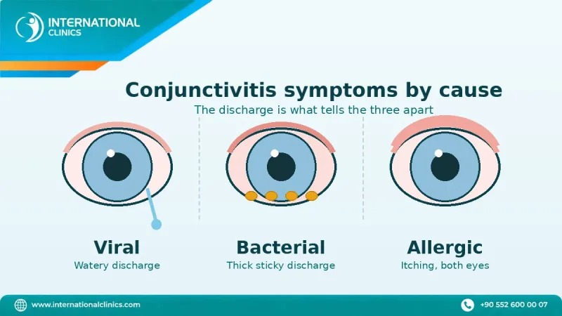 Conjunctivitis symptoms compared by cause: viral, bacterial and allergic