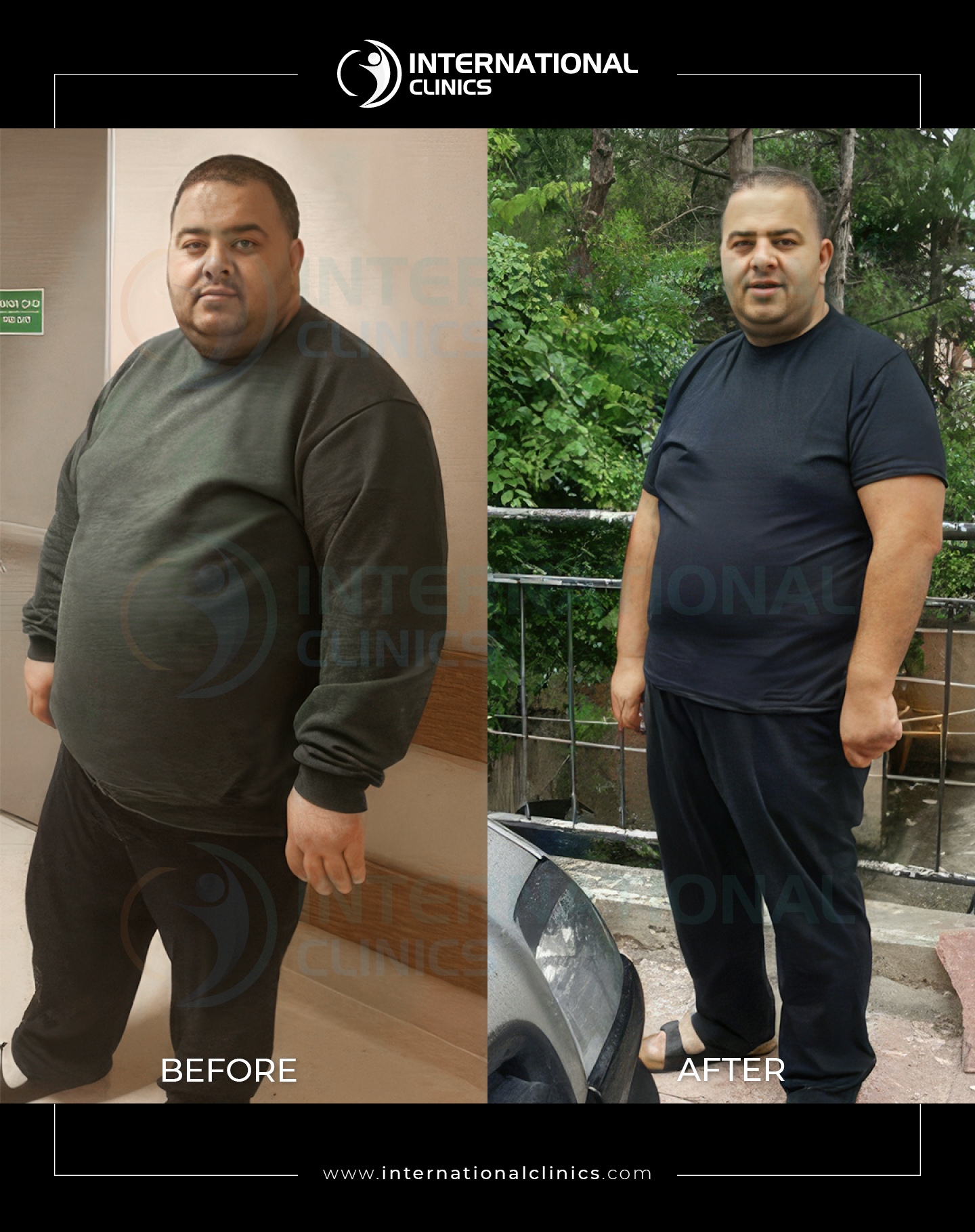 Gastric Sleeve 