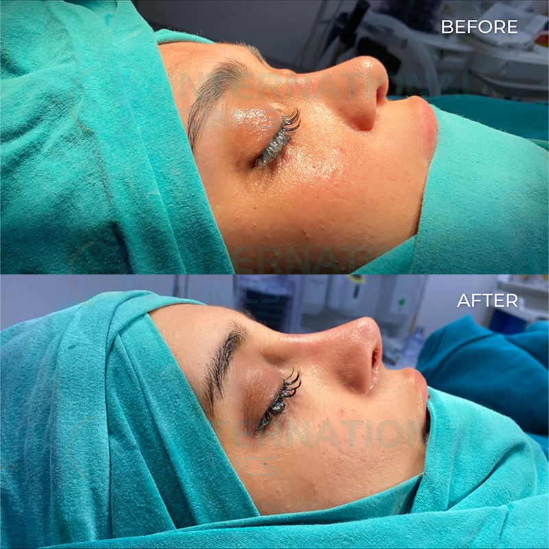 Rinoplastia de revisión