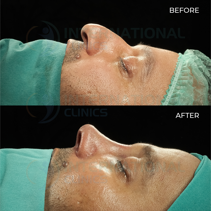 Rinoplastia de revisión