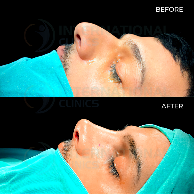 Rinoplastia primaria