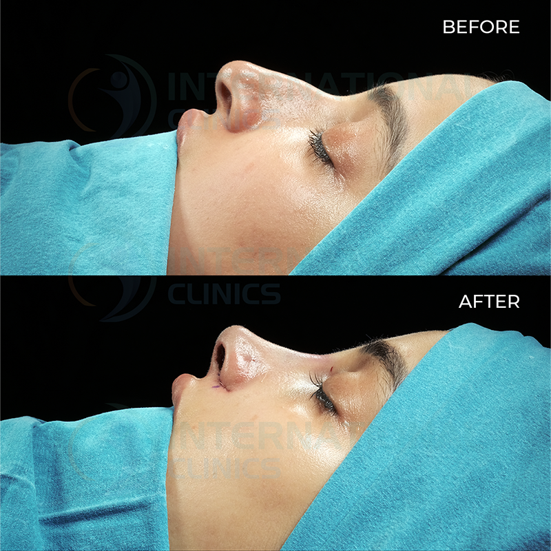 Rinoplastia primaria