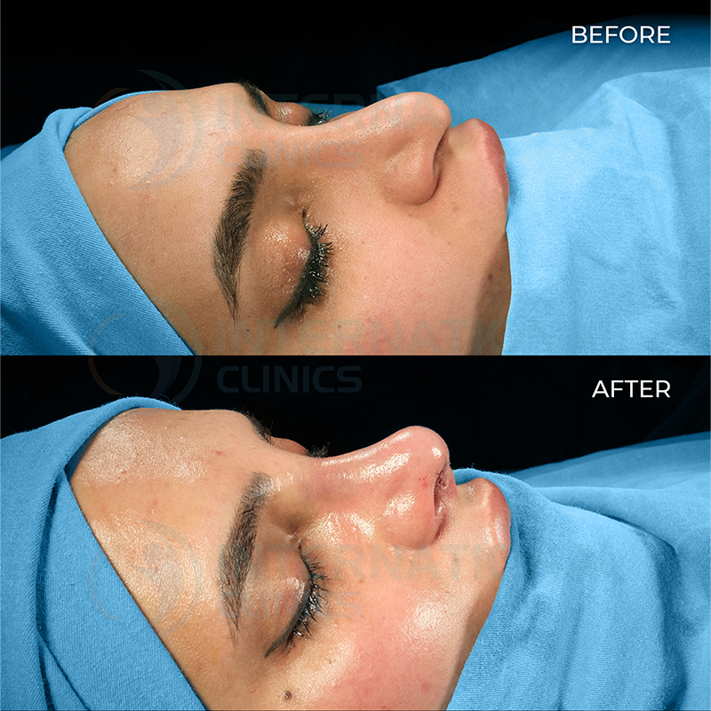 Rinoplastia primaria