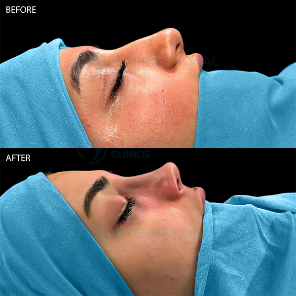 Rinoplastia primaria
