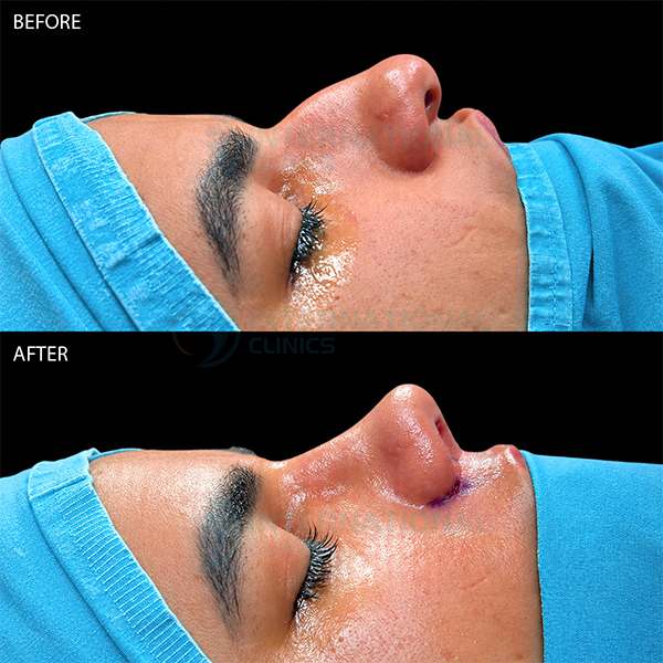 Rinoplastia primaria