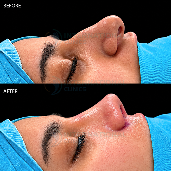 Rinoplastia primaria