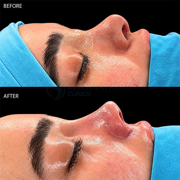 Rinoplastia primaria