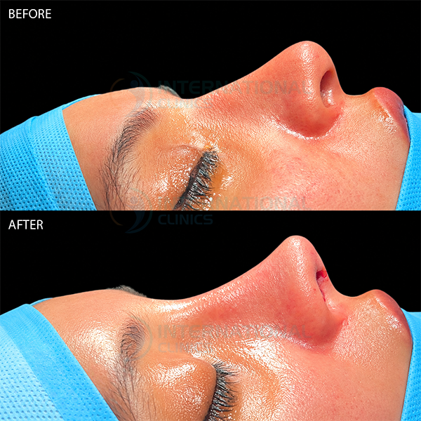 Rinoplastia primaria