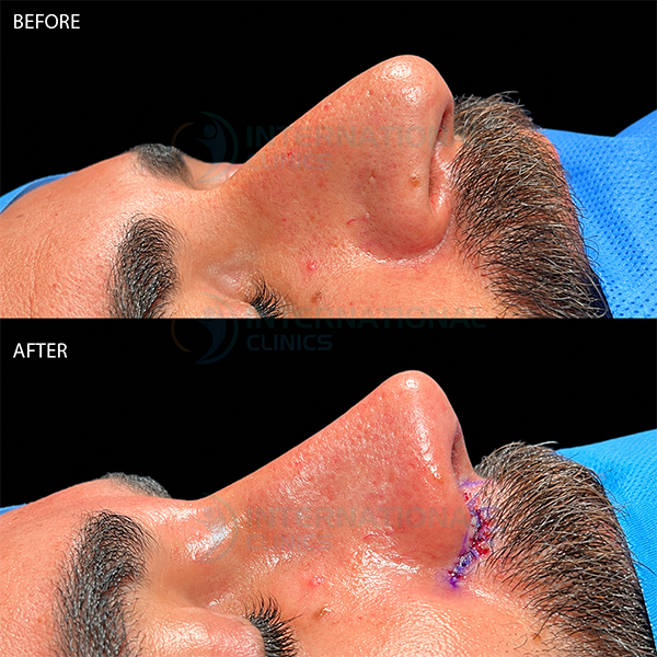 Rinoplastia primaria