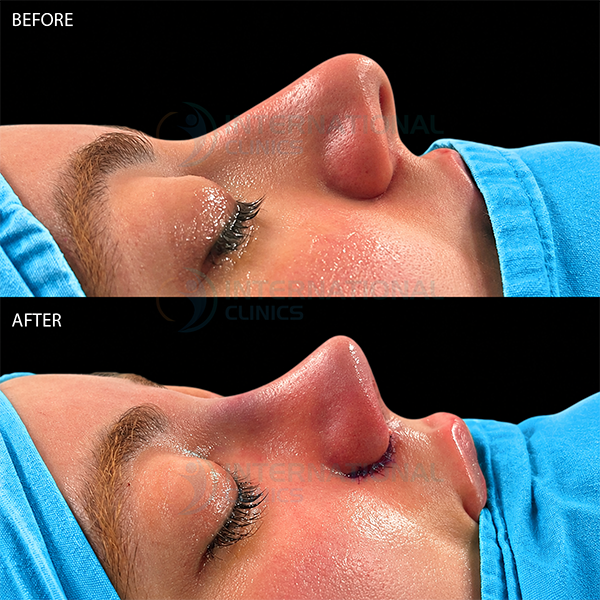 Rinoplastia primaria