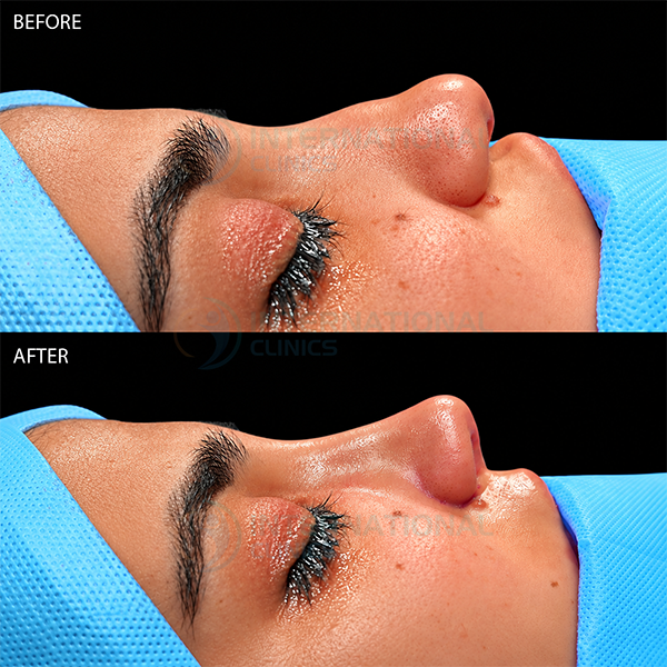 Rinoplastia primaria