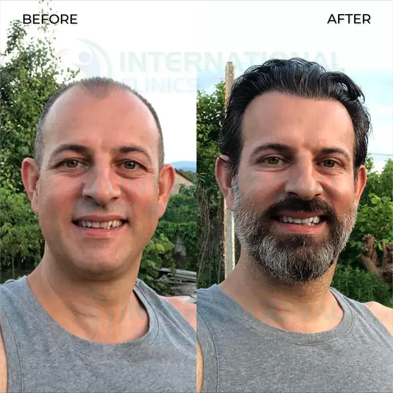 زراعة الشعر قبل وبعد  بالصور