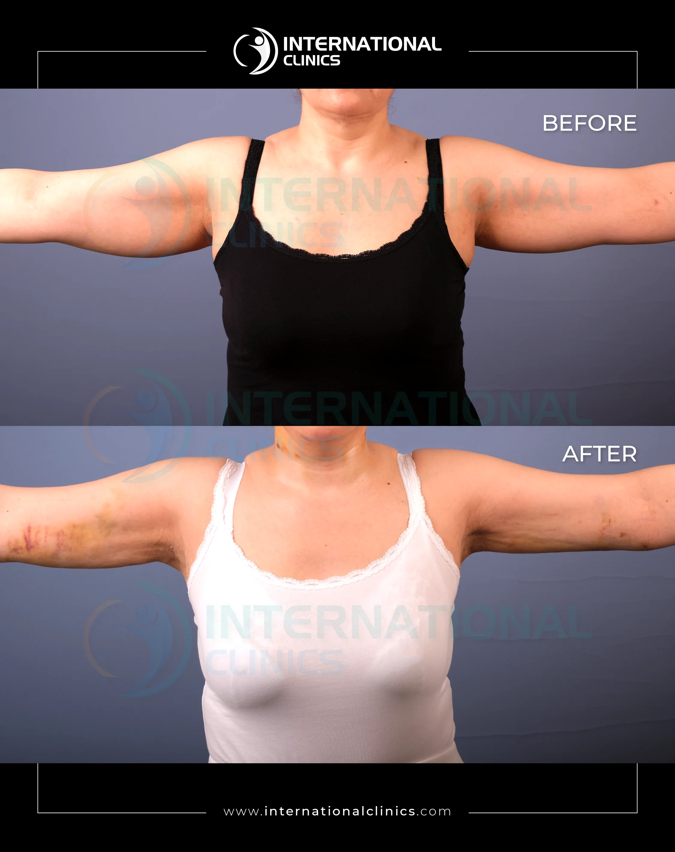 Arm Lift Before &amp; After