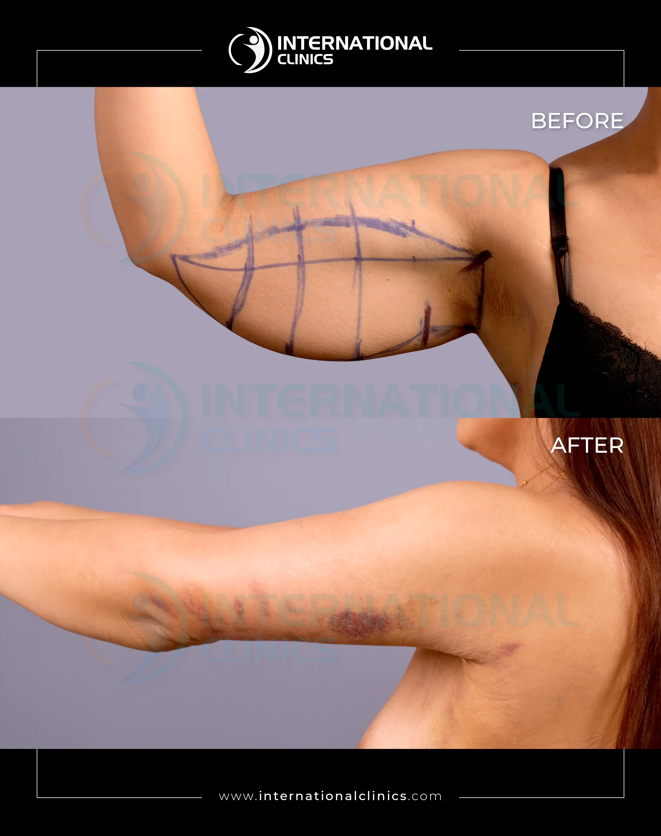 Arm Lift Before &amp; After