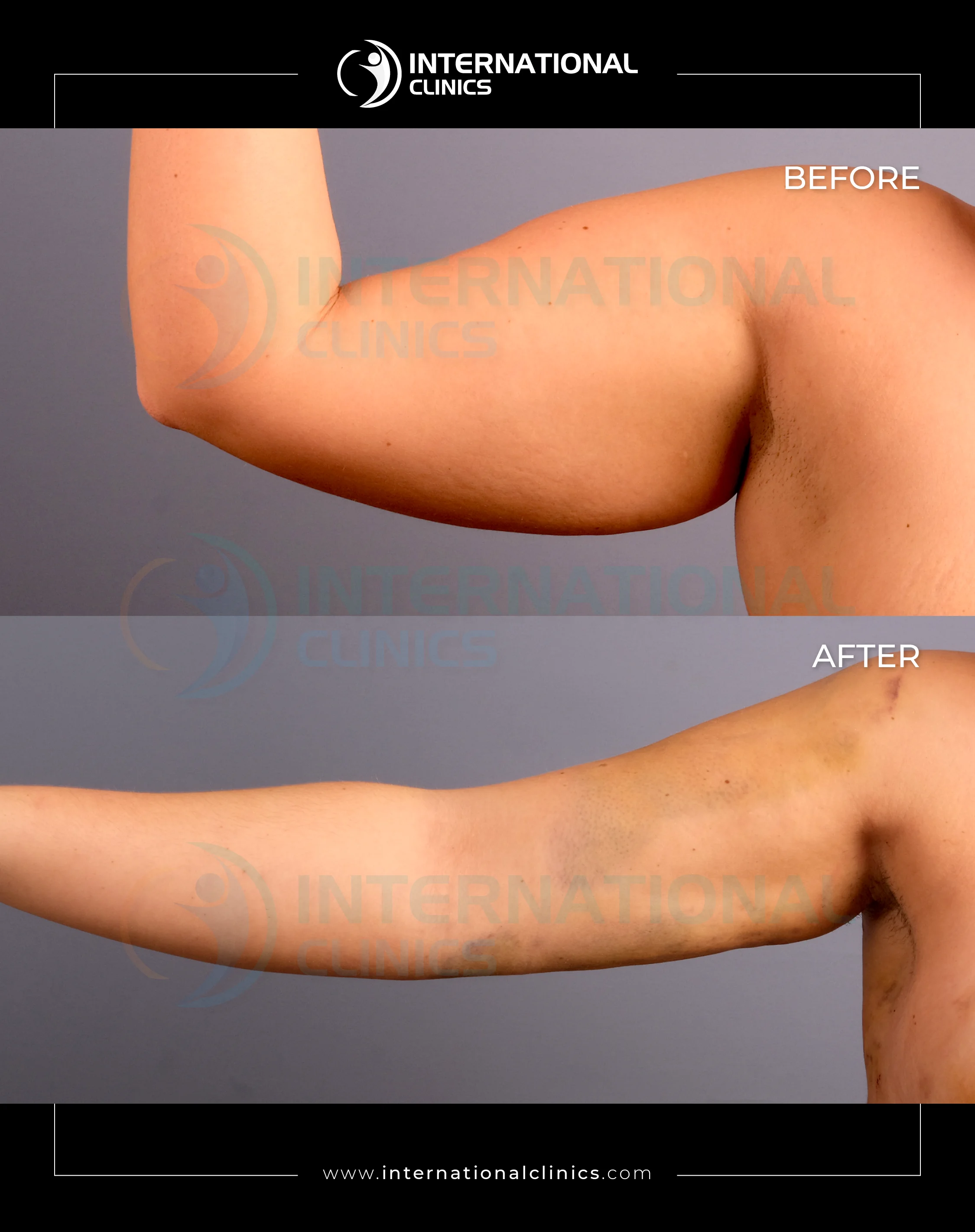 Arm Lift Before &amp; After