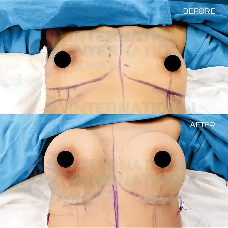 Breast Augmentation Before and After in Turkey