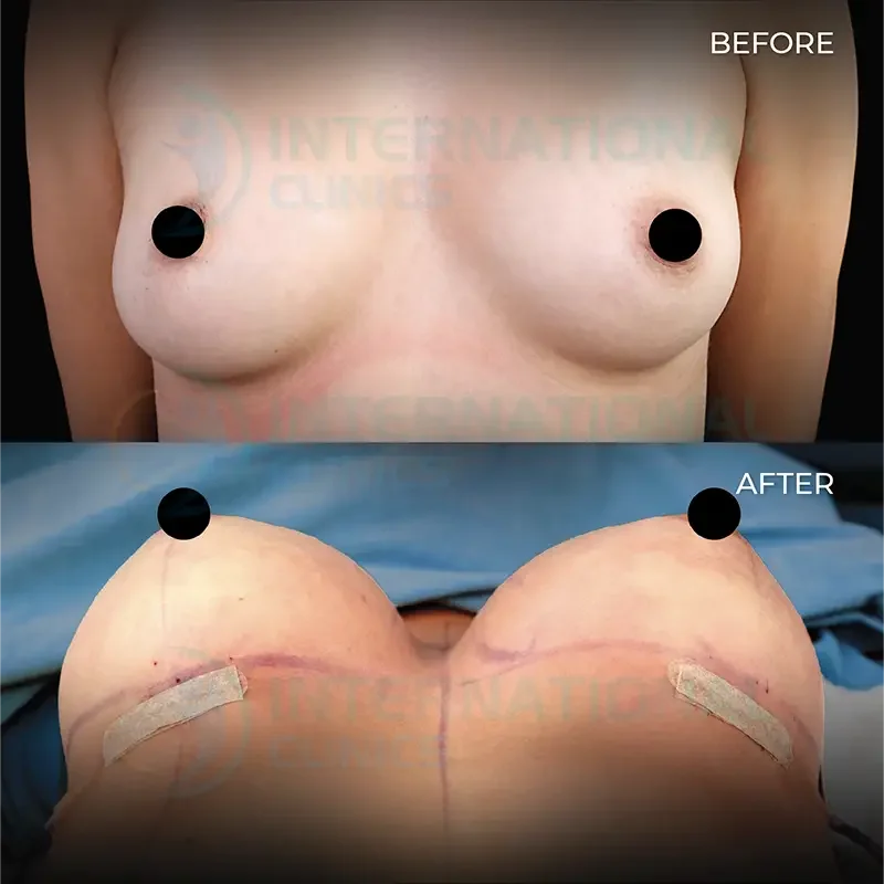 Breast Augmentation Before and After in Turkey