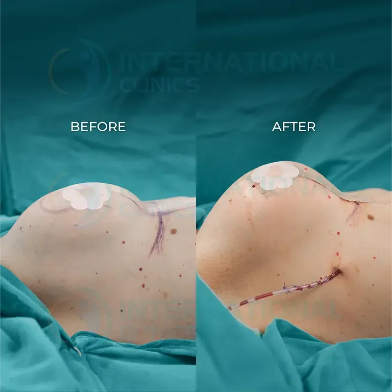Breast Augmentation Before and After in Turkey