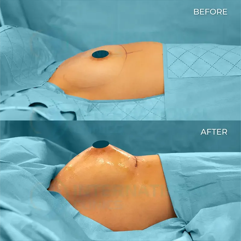 Breast Augmentation Before and After in Turkey