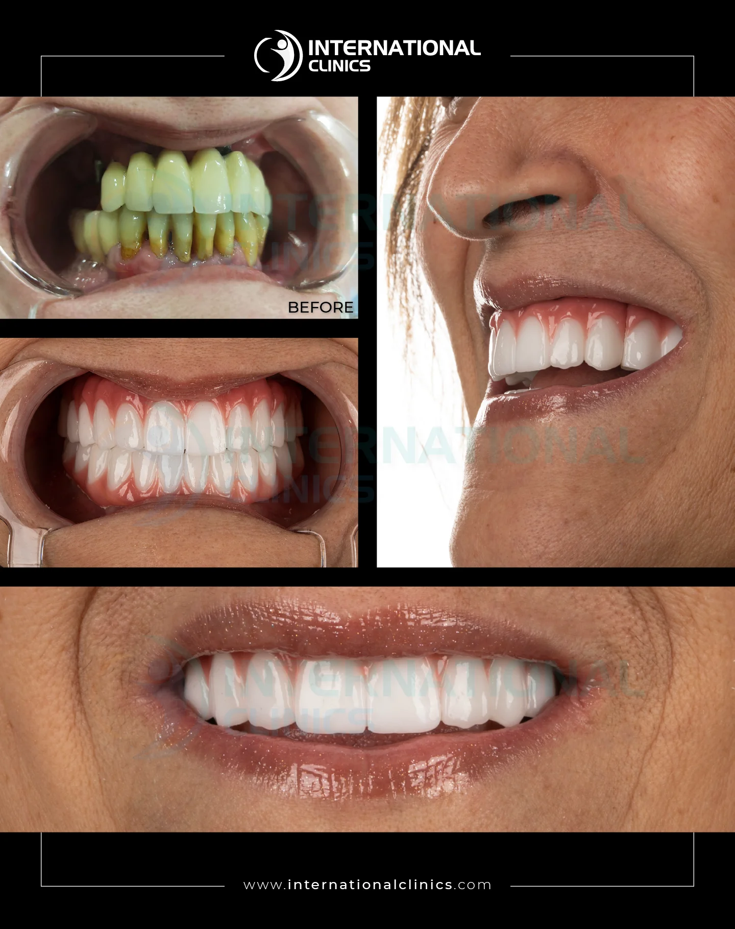 All On Four, Six Before &amp; After