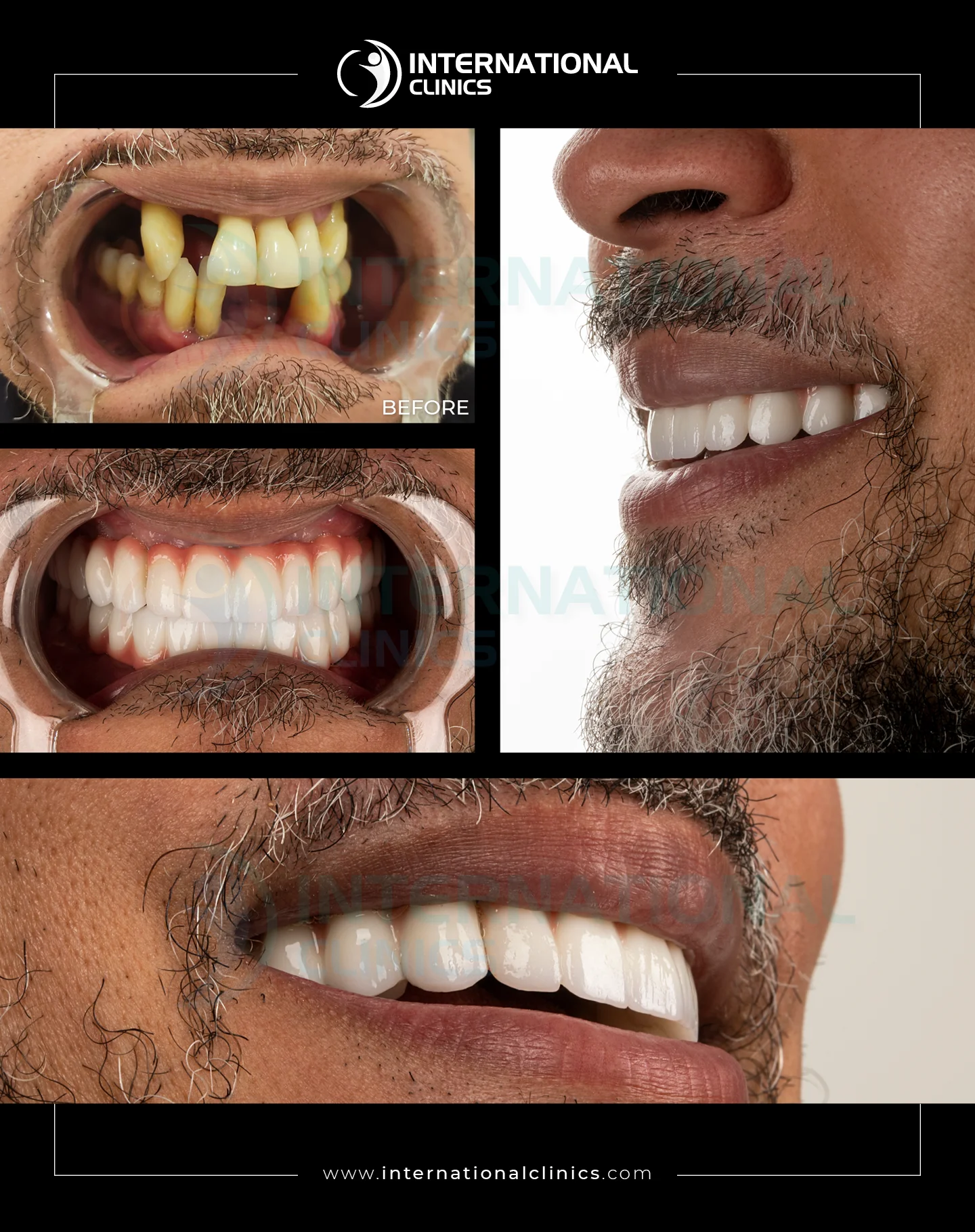 All On Four, Six Before &amp; After