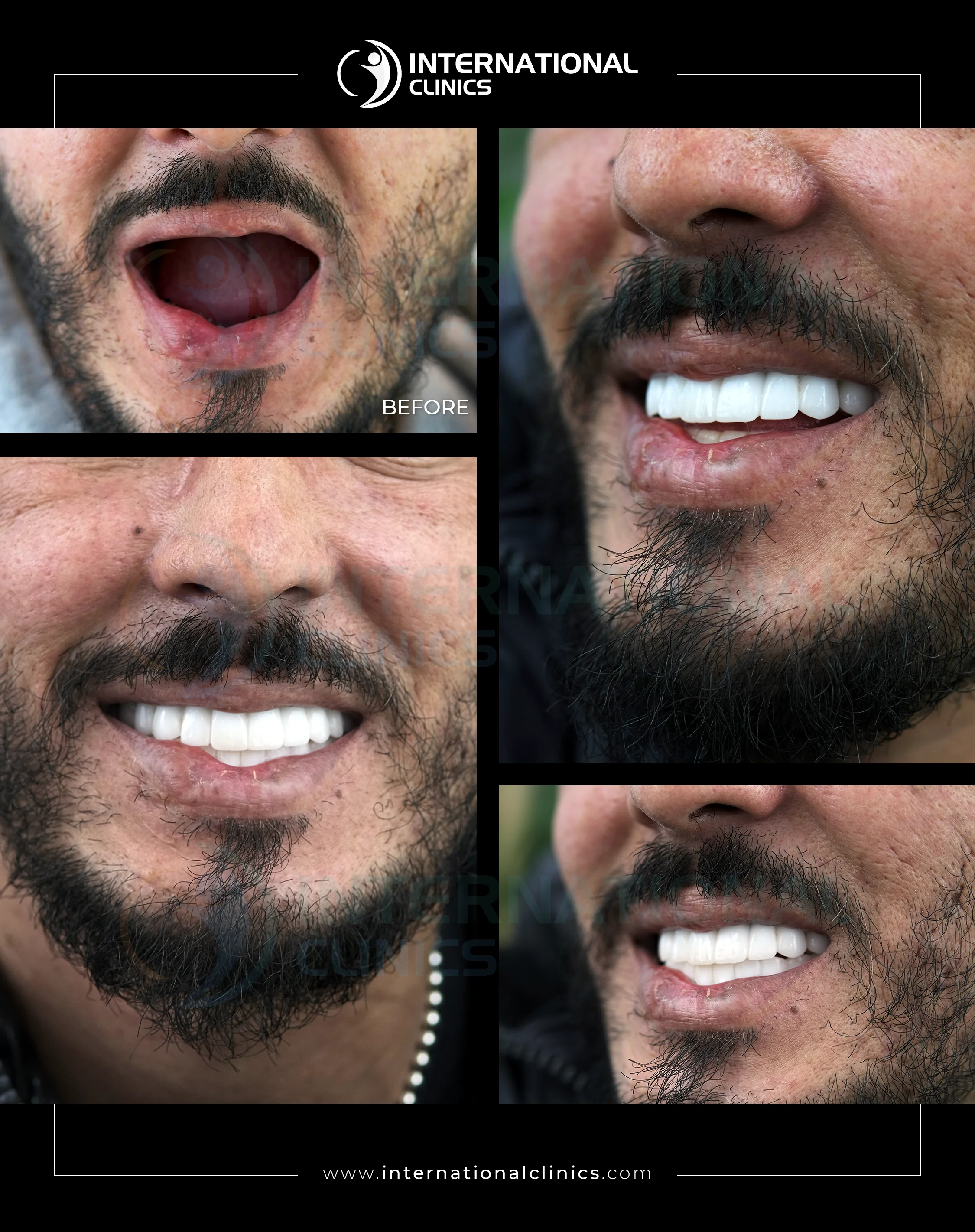 All On Four, Six Before &amp; After