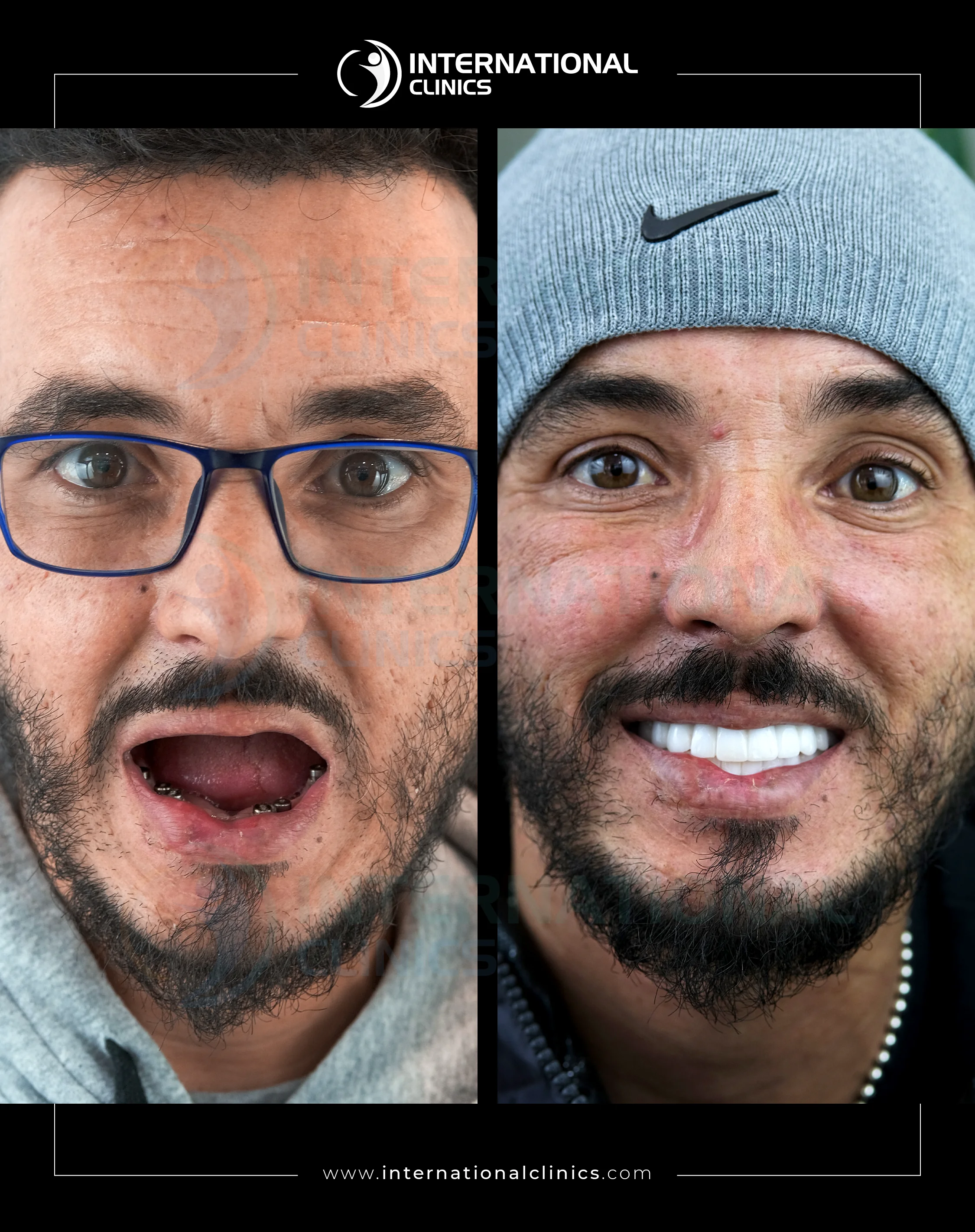 All On Four, Six Before &amp; After