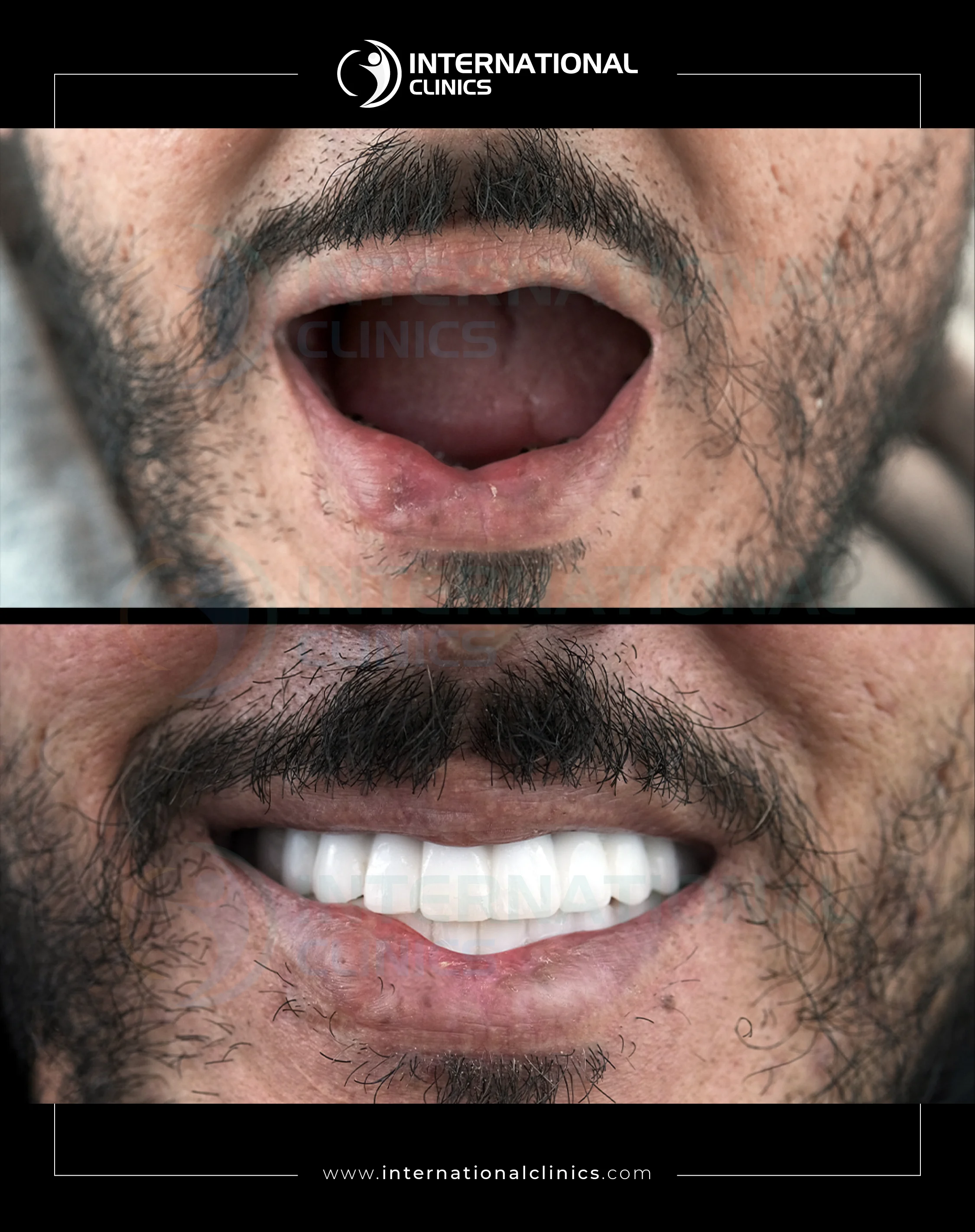 All On Four, Six Before &amp; After