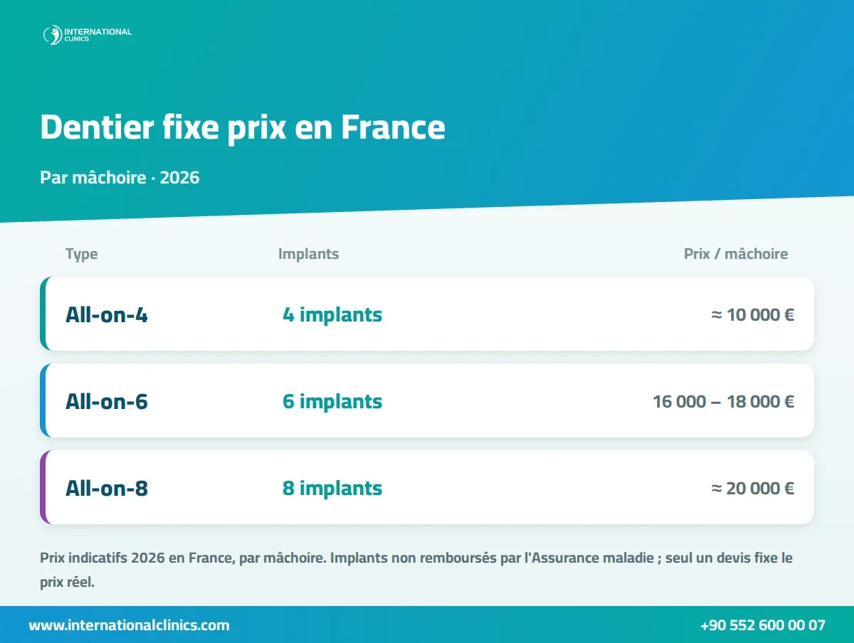Infographie du prix d'un dentier fixe en France en 2026 : All-on-4, All-on-6 et All-on-8 par mâchoire