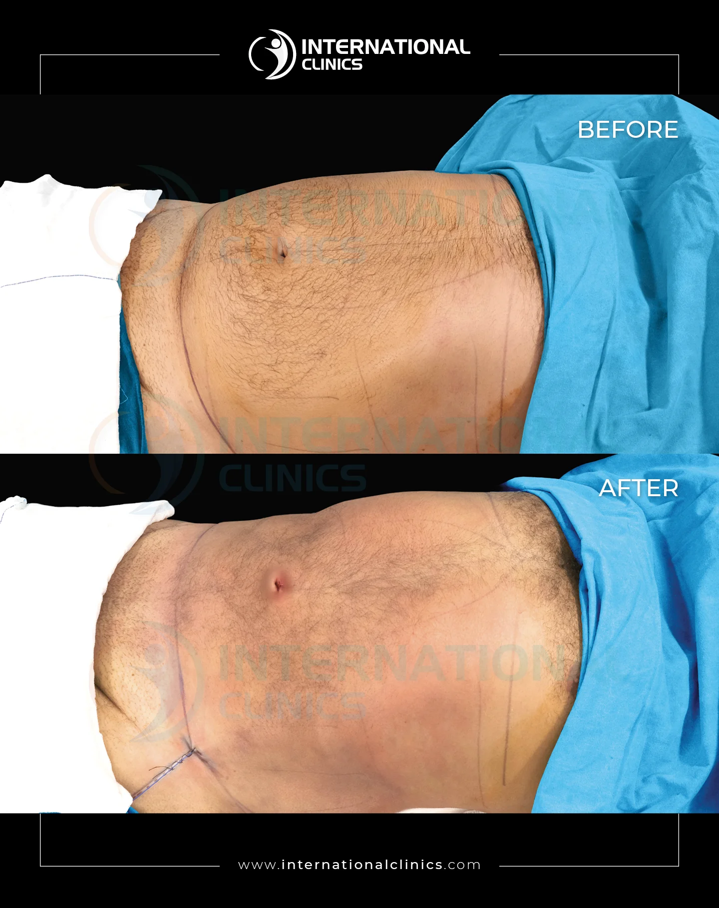  Liposuction Before &amp; After