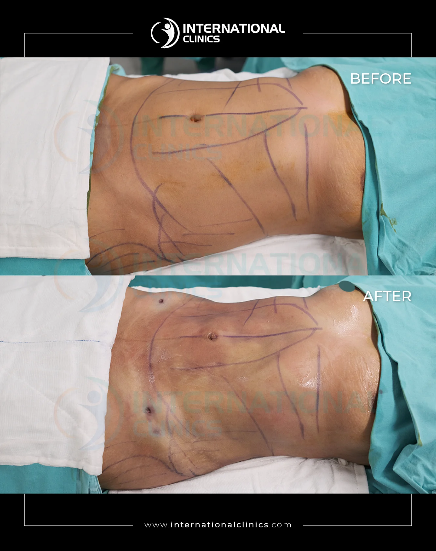  Liposuction Before &amp; After