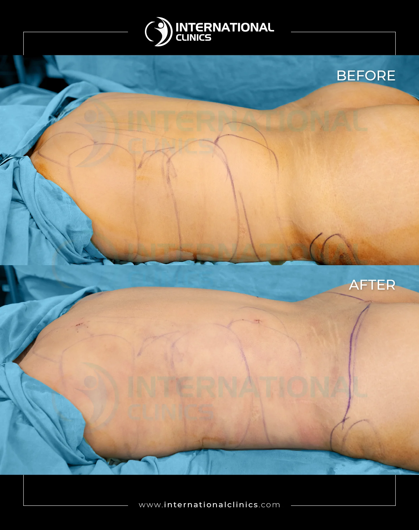  Liposuction Before &amp; After