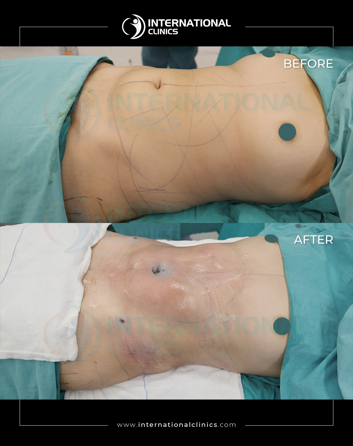  Liposuction Before &amp; After