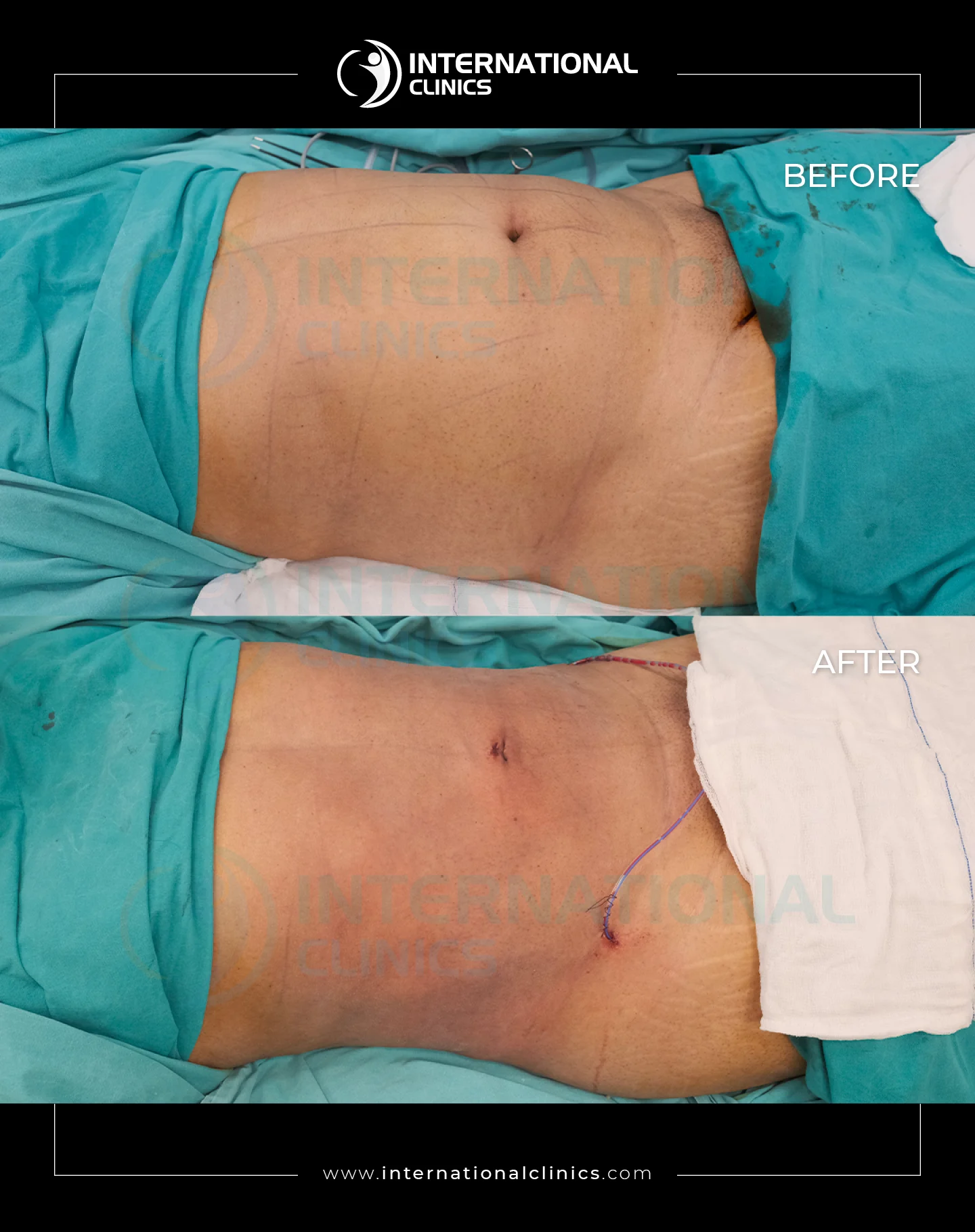  Liposuction Before &amp; After