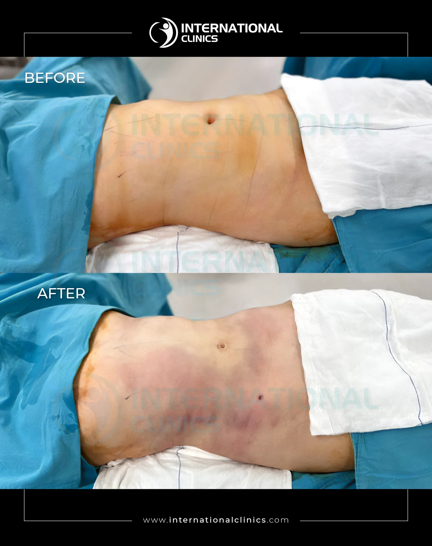  Liposuction Before &amp; After