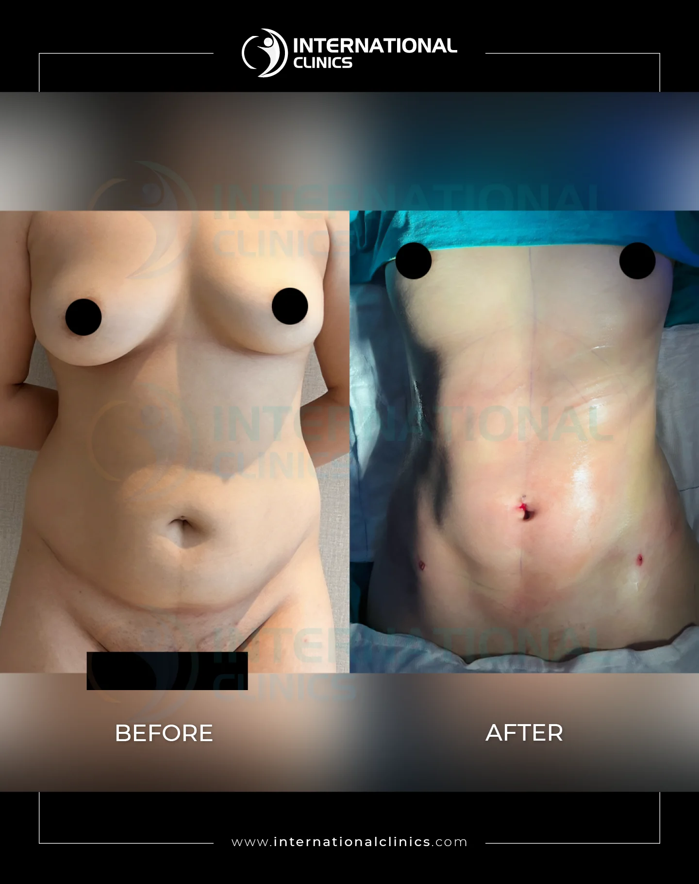  Liposuction Before &amp; After