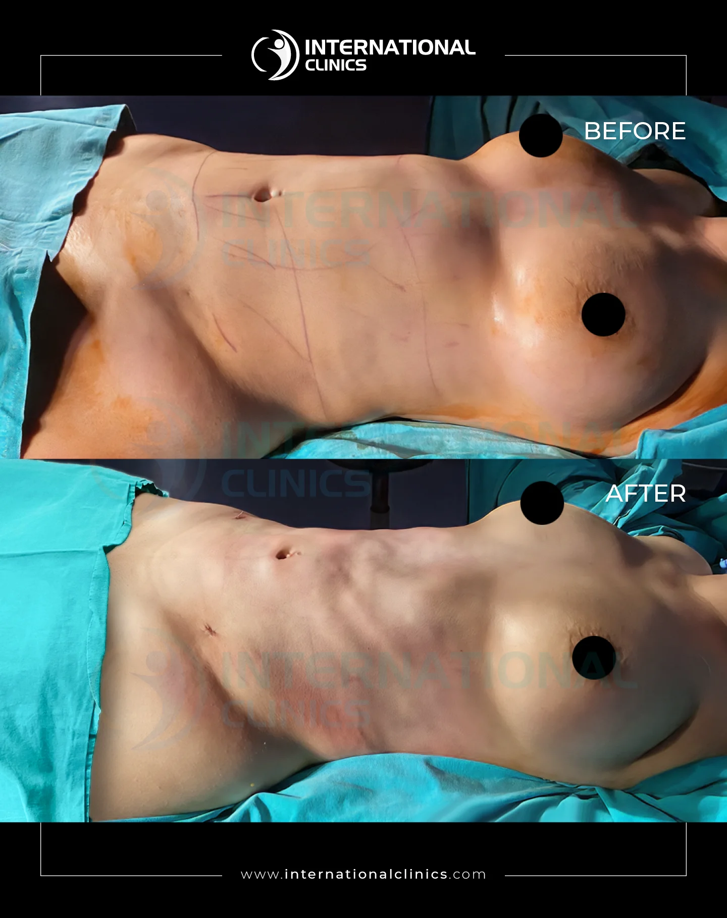  Liposuction Before &amp; After