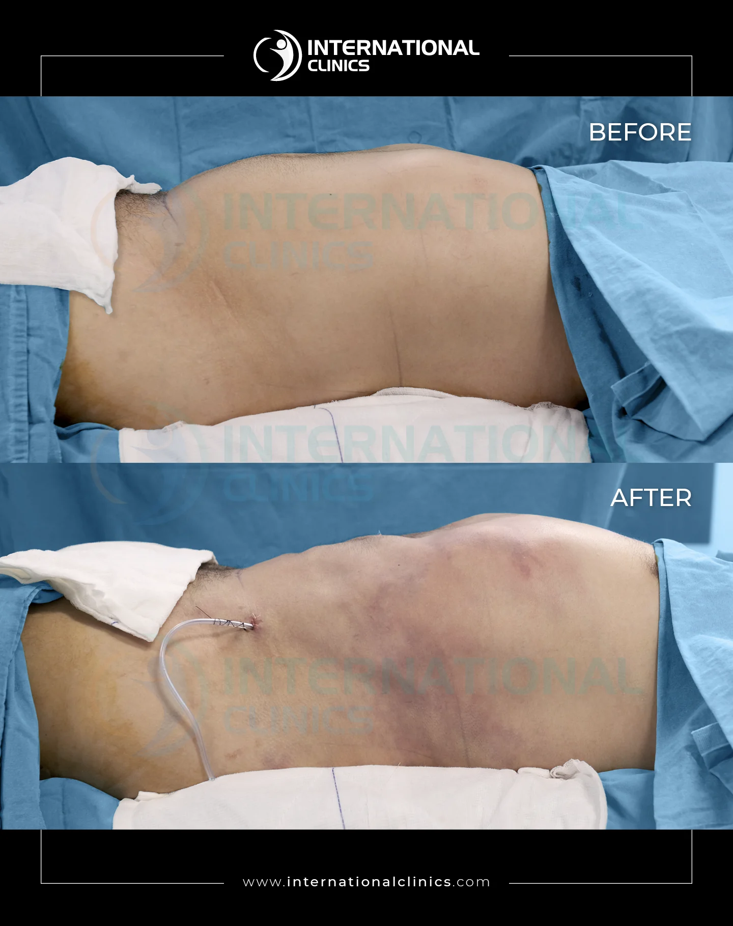  Liposuction Before &amp; After