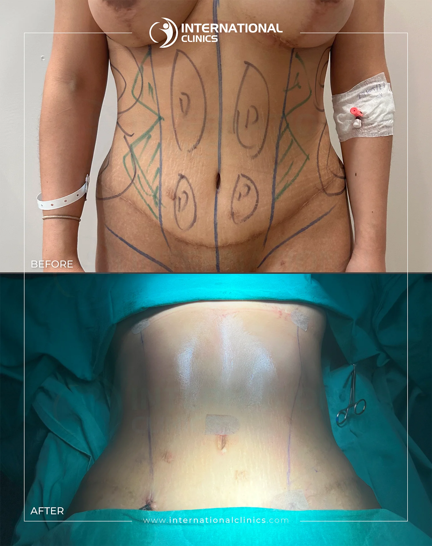  Liposuction Before &amp; After
