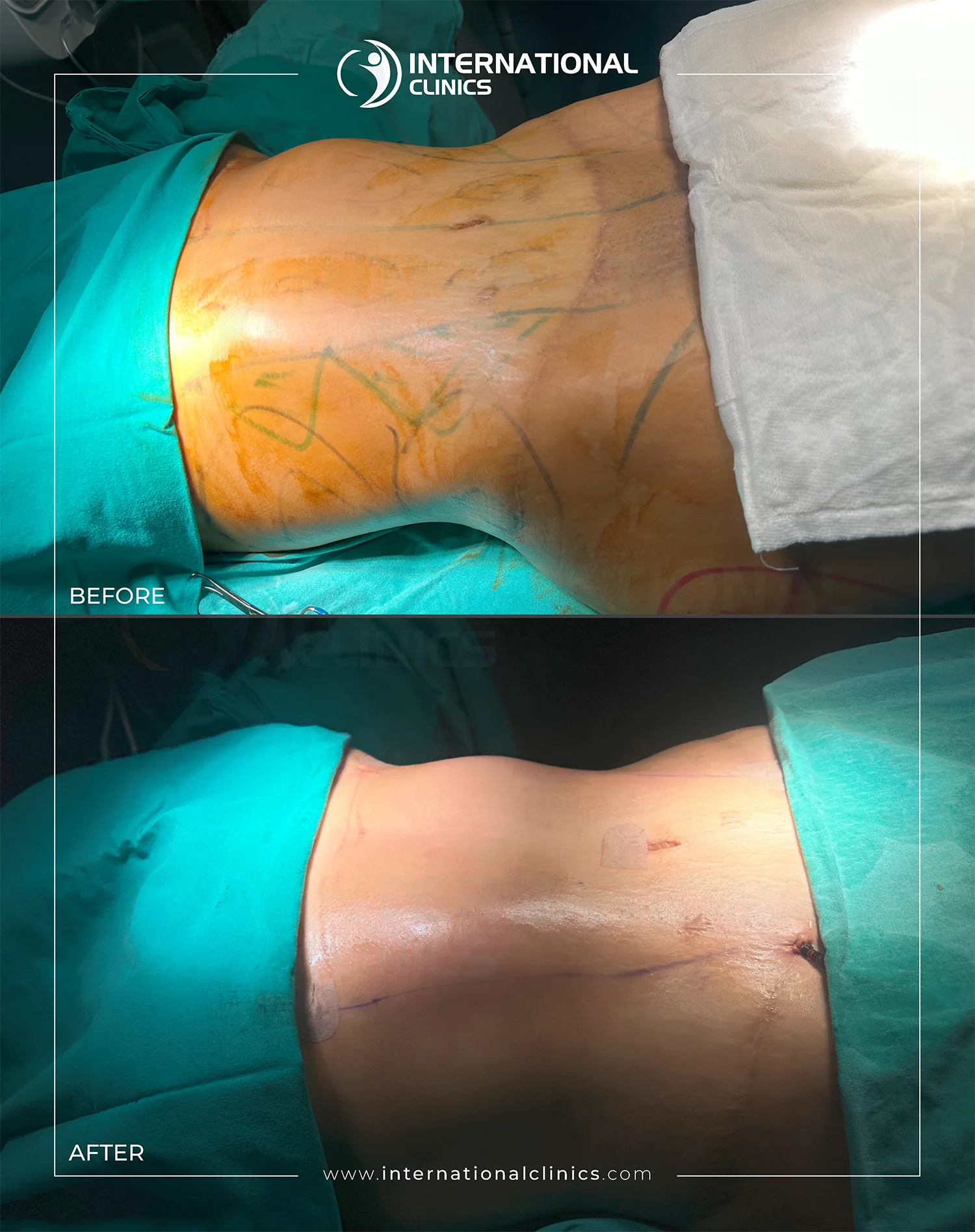  Liposuction Before &amp; After