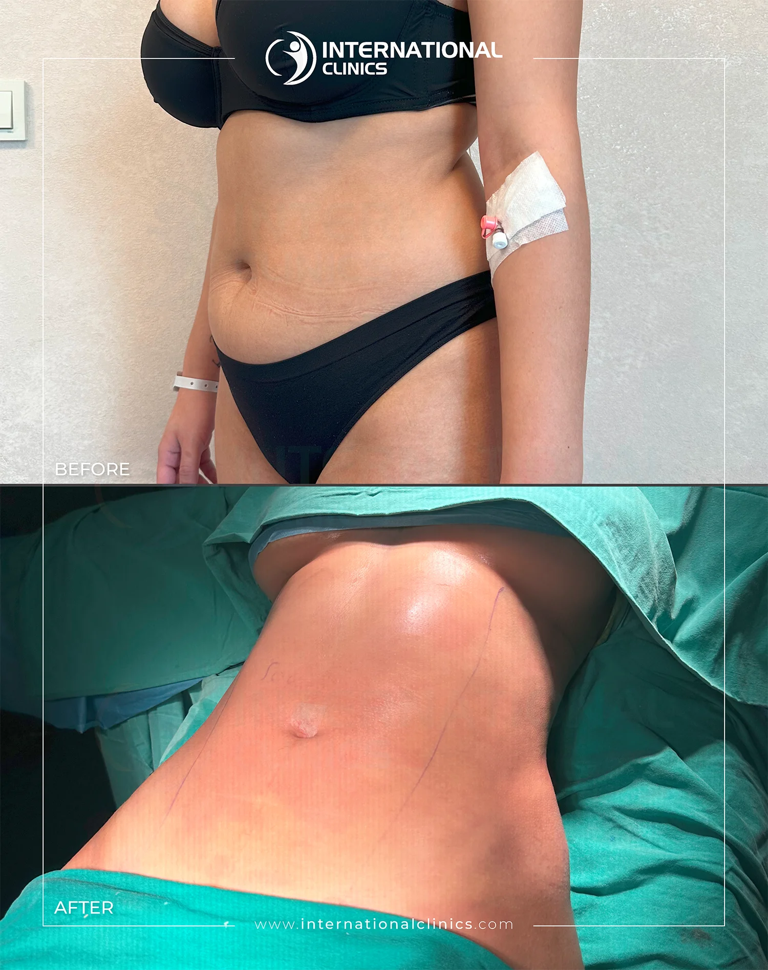  Liposuction Before &amp; After