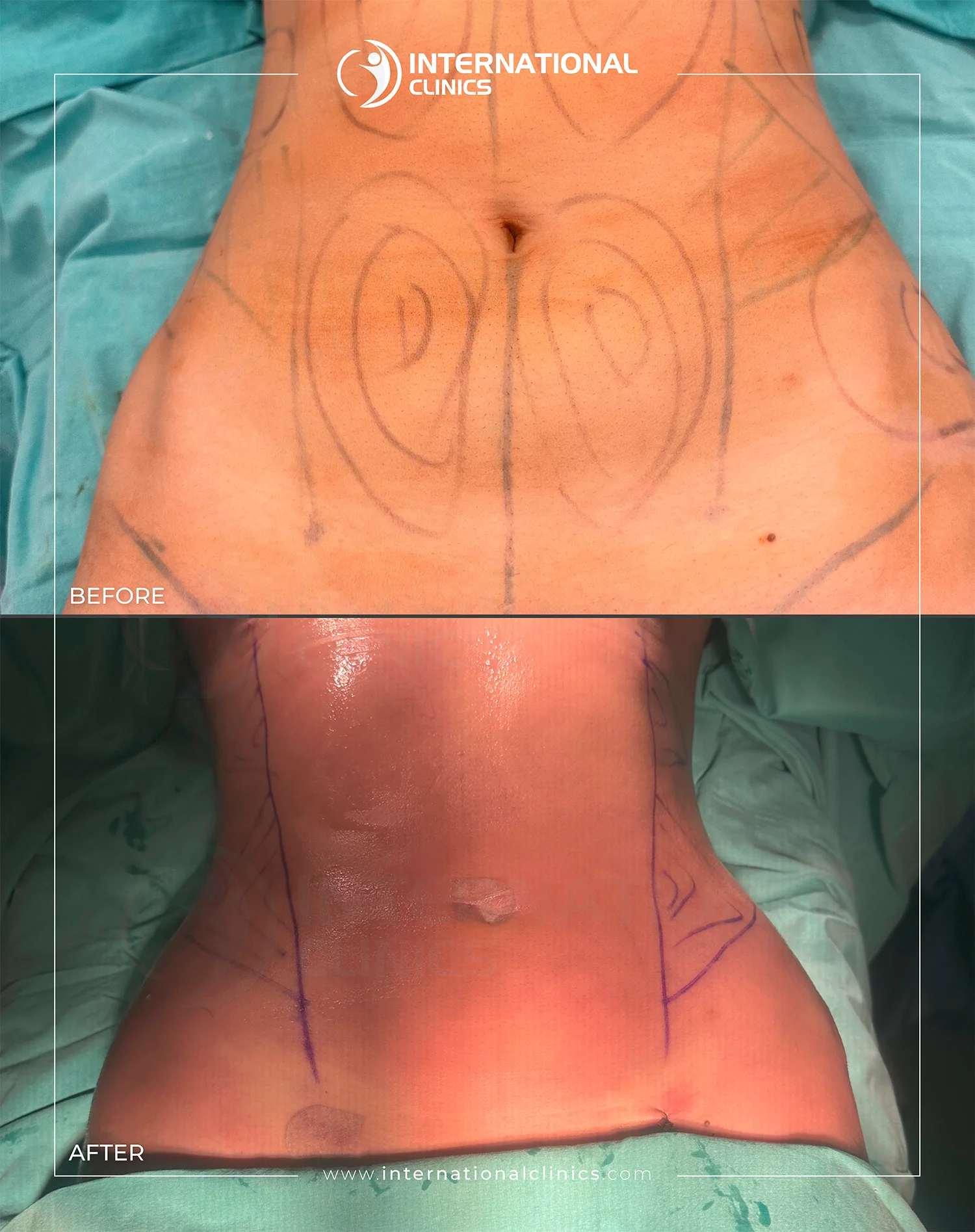 شفط الدهون في تركيا قبل  و بعد