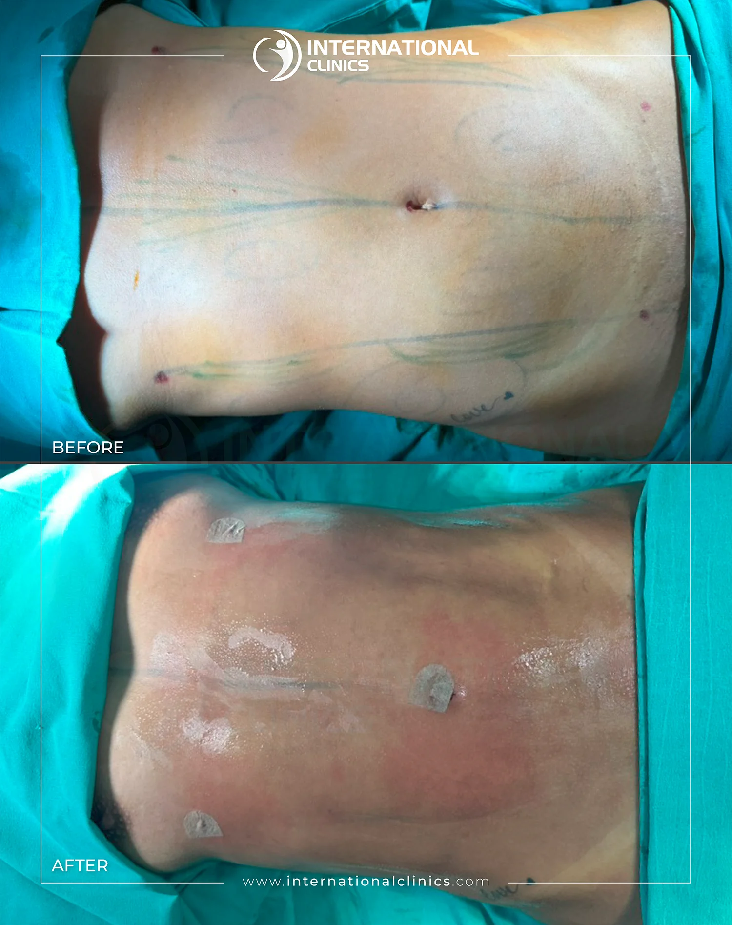  Liposuction Before &amp; After