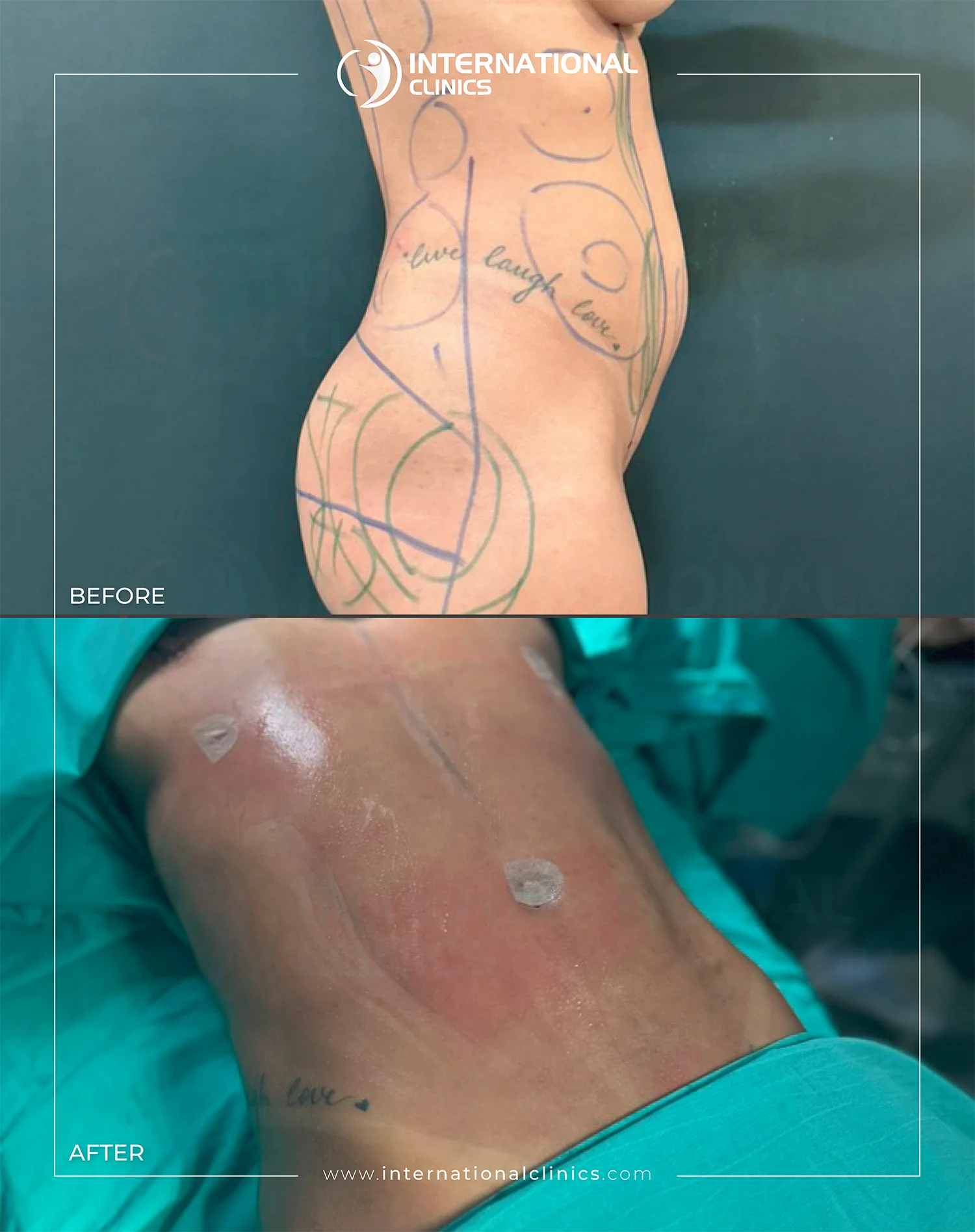 Liposuction Before &amp; After