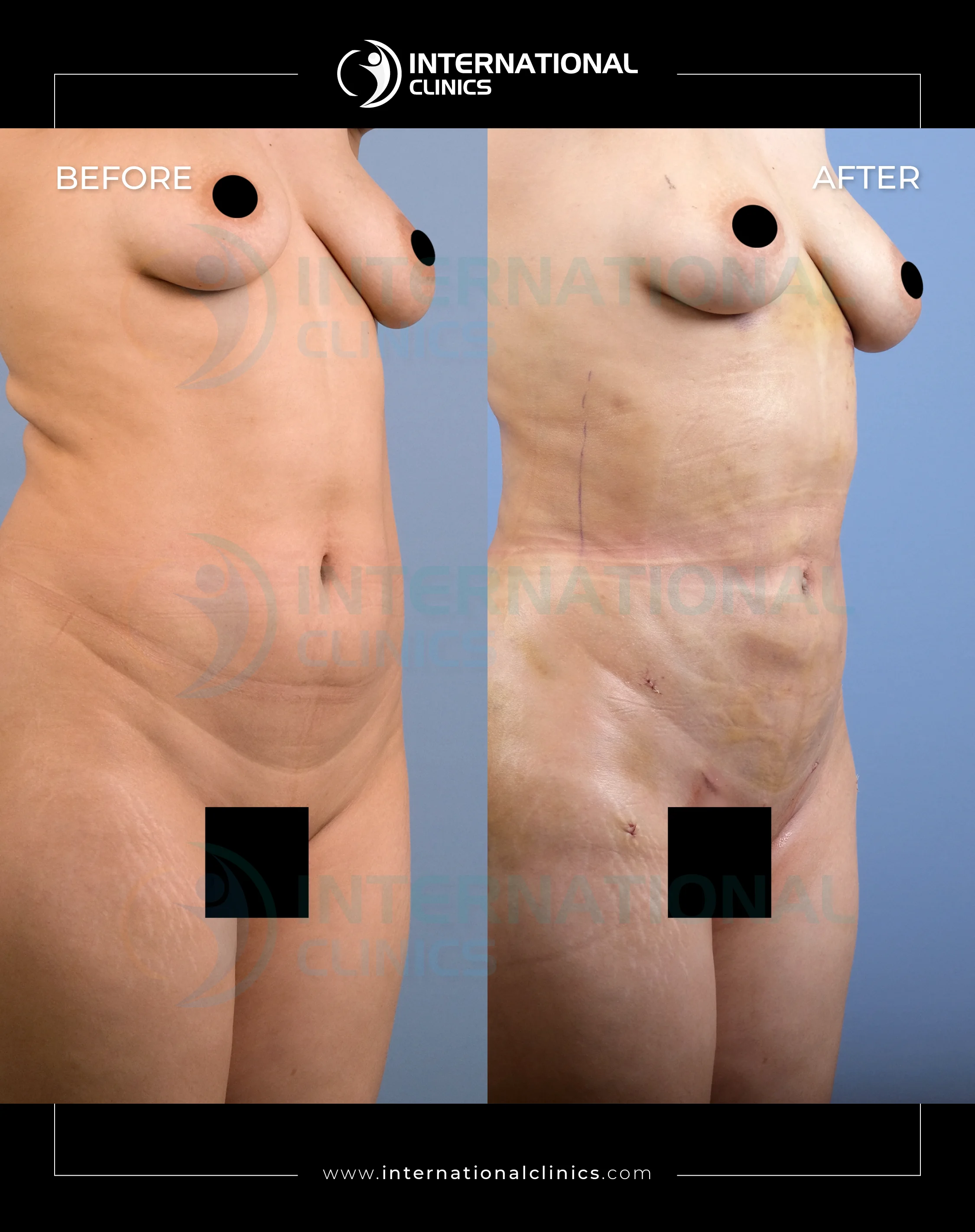 شفط الدهون في تركيا قبل  و بعد