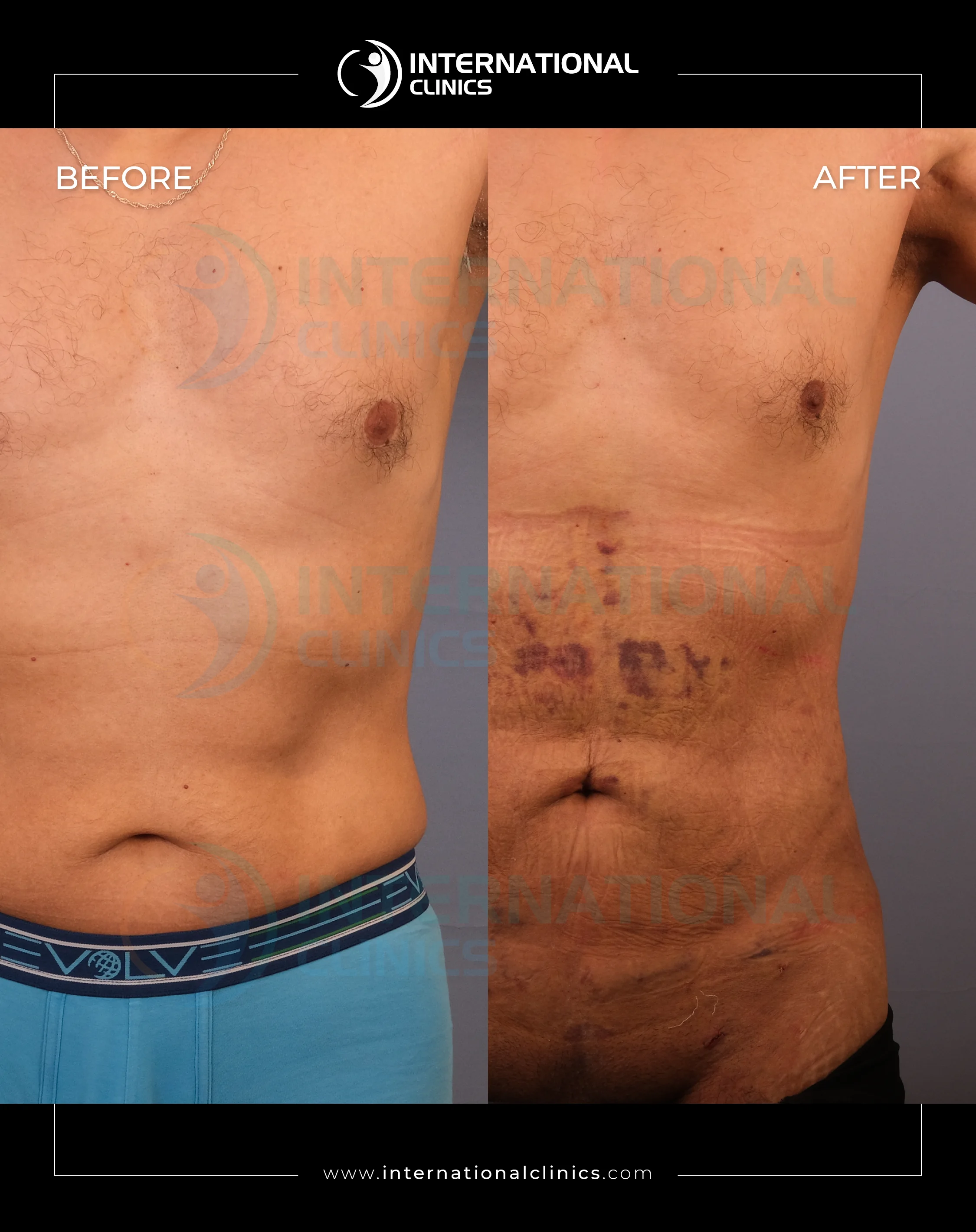 شفط الدهون في تركيا قبل  و بعد