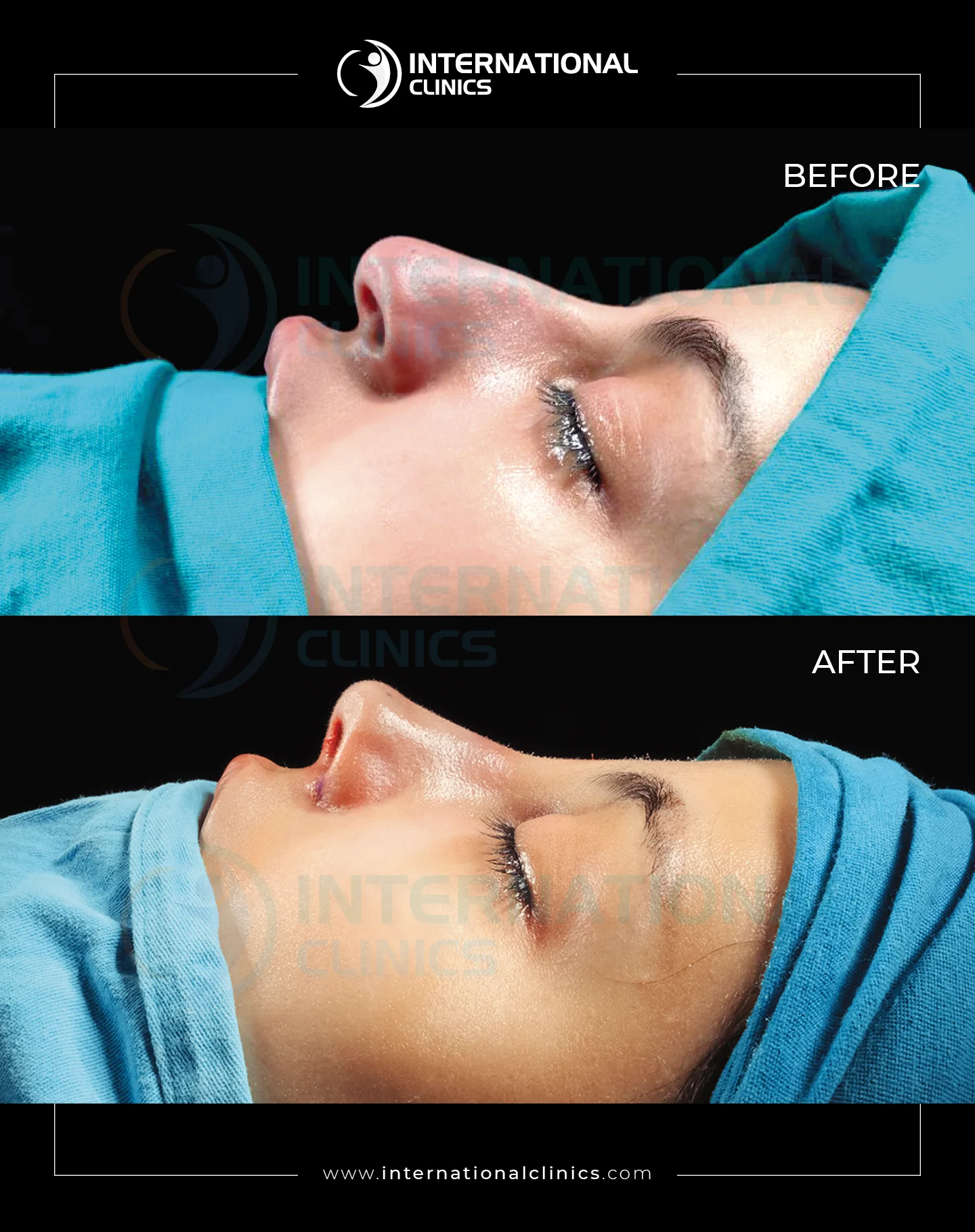 Rhinoplasty  Before &amp; After