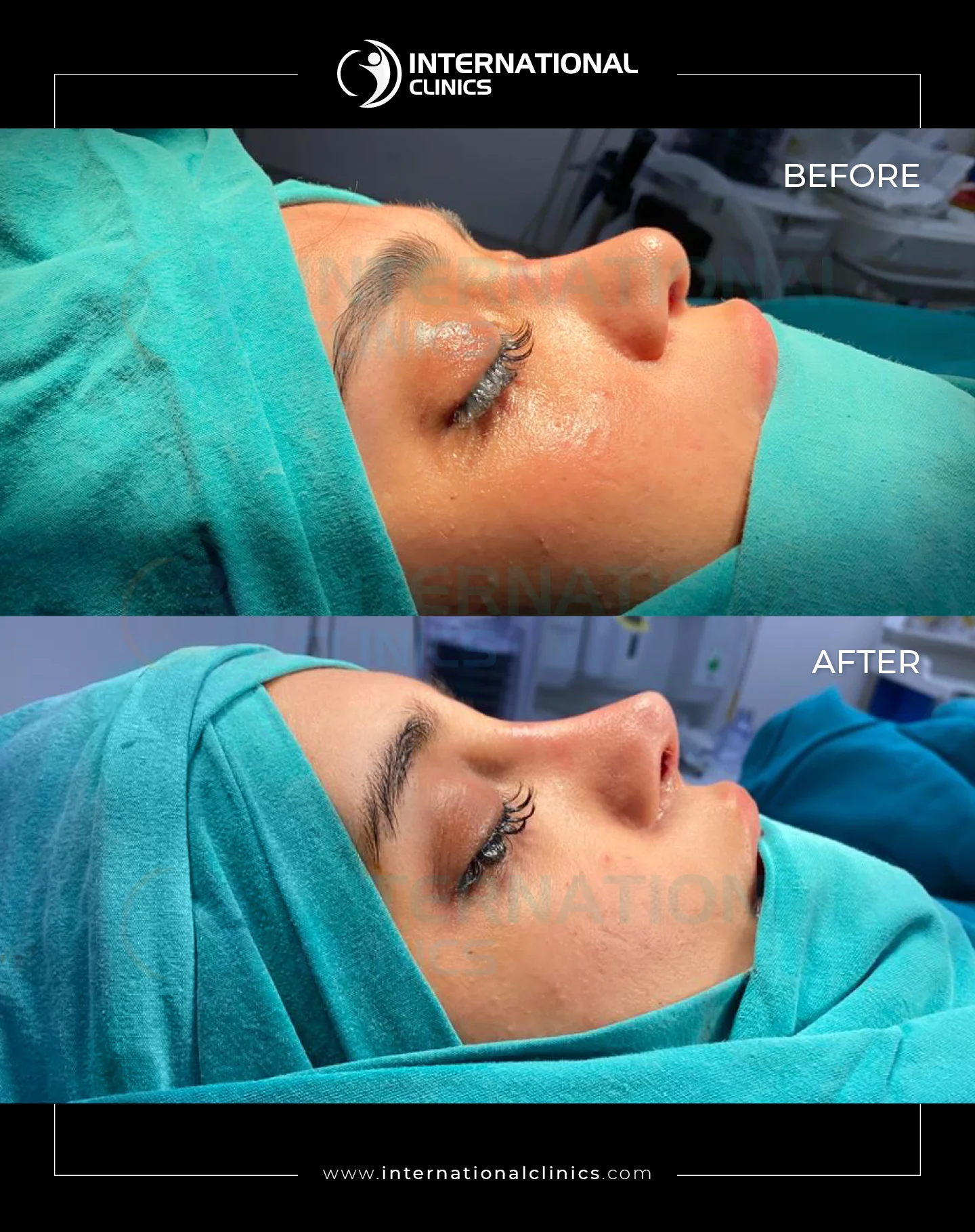 Rhinoplasty  Before &amp; After